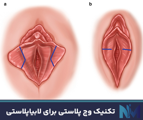 تکنیک-وج-پلاستی-برای-لابیاپلاستی