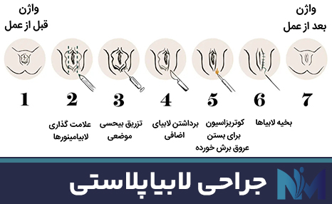 جراحی-لابیاپلاستی