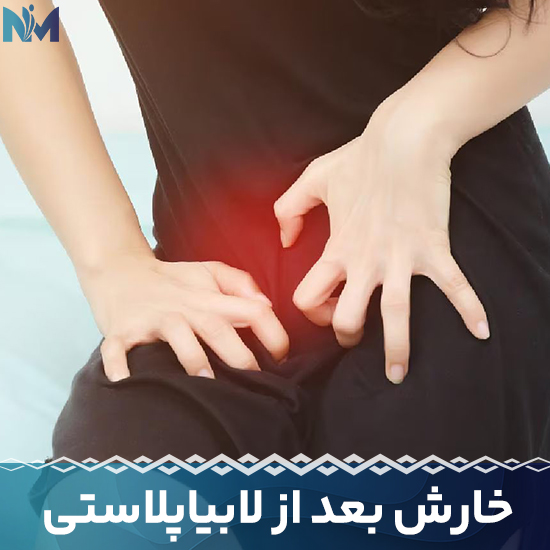 خارش-بعد-از-لابیاپلاستی