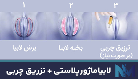 لابیاماژورپلاستی-+-تزریق-چربی