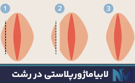 لابیاماژورپلاستی-در-رشت