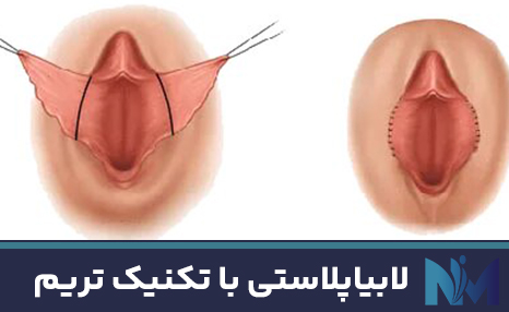 لابیاپلاستی-با-تکنیک-تریم