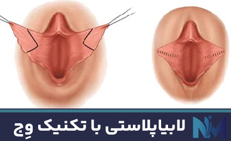 لابیاپلاستی-با-تکنیک-وِج