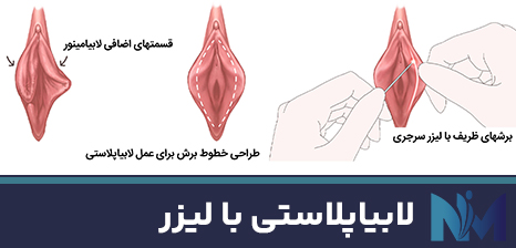 لابیاپلاستی-با-لیزر