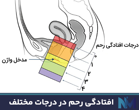 افتادگی-رحم-در-درجات-مختلف