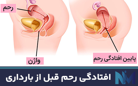 افتادگی-رحم-قبل-از-بارداری