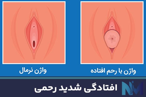 افتادگی-شدید-رحمی