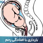 بارداری-با-افتادگی-رحم