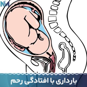 بارداری-با-افتادگی-رحم