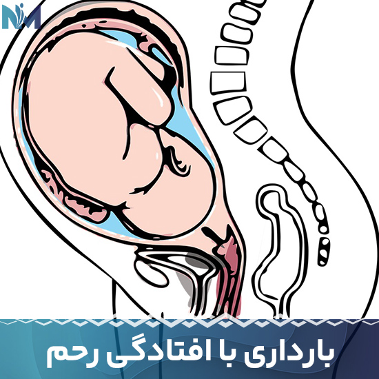 بارداری-با-افتادگی-رحم