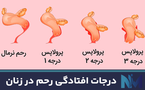 درجات-افتادگی-رحم-در-زنان