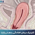 کلینیک-درمان-افتادگی-رحم-در-رشت