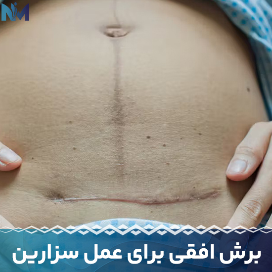 برش-افقی-برای-عمل-سزارین