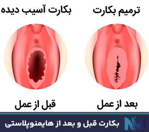 بکارت-قبل-و-بعد-از-هایمنوپلاستی