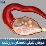 درمان-تنبلی-تخمدان-در-رشت