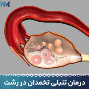 درمان-تنبلی-تخمدان-در-رشت