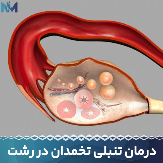 درمان-تنبلی-تخمدان-در-رشت