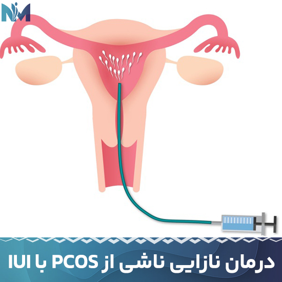 درمان-نازایی-ناشی-از-PCOS-با-IUI