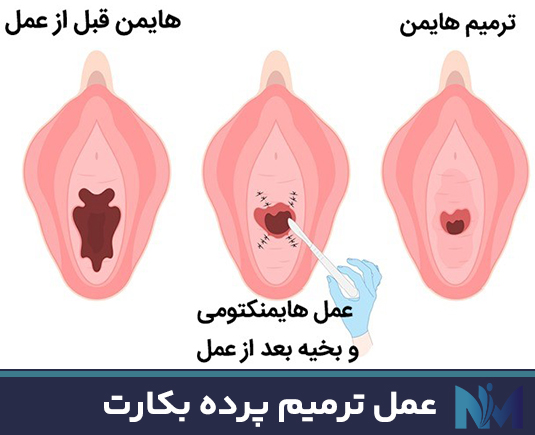 عمل-ترمیم-پرده-بکارت