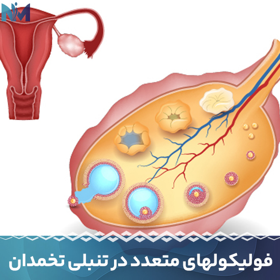 فولیکولهای-متعدد-در-تنبلی-تخمدان