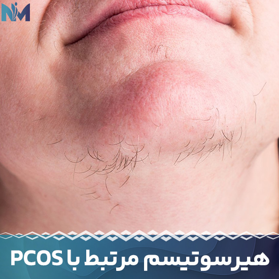 هیرسوتیسم-مرتبط-با-PCOS
