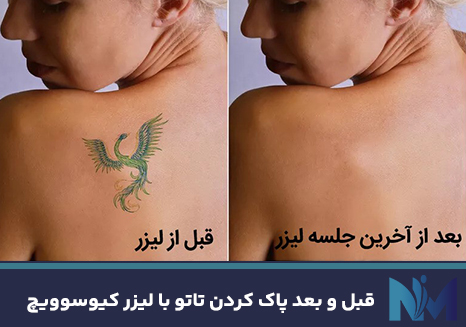 قبل-و-بعد-پاک-کردن-تاتو-با-لیزر-کیوسوویچ