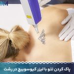 پاک-کردن-تتو-با-لیزر-کیوسوییچ-در-رشت