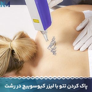 پاک-کردن-تتو-با-لیزر-کیوسوییچ-در-رشت