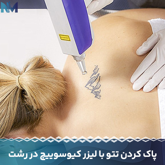 پاک-کردن-تتو-با-لیزر-کیوسوییچ-در-رشت