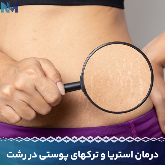 درمان-استریا-و-ترکهای-پوستی-در-رشت