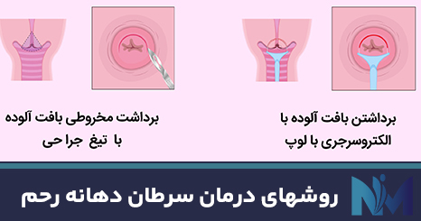 روشهای-درمان-سرطان-دهانه-رحم