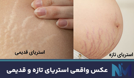 عکس-واقعی-استریای-تازه-و-قدیمی