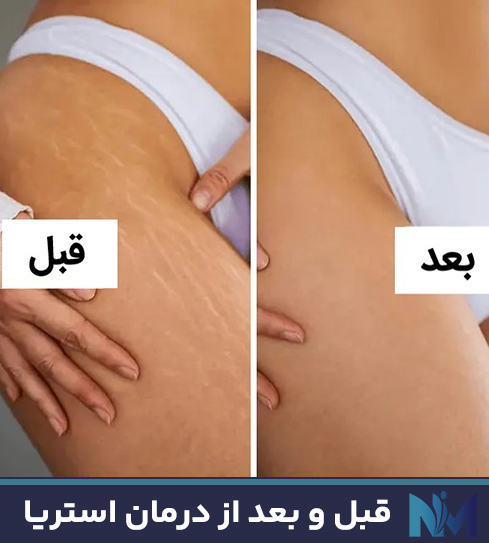 قبل-و-بعد-از-درمان-استریا