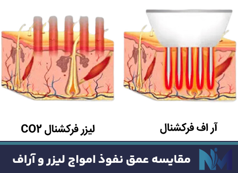 مقایسه-عمق-نفوذ-امواج-لیزر-و-آراف