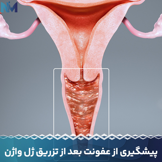 پیشگیری-از-عفونت-بعد-از-تزریق-ژل-واژن