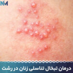 درمان-تبخال-تناسلی-زنان-در-رشت