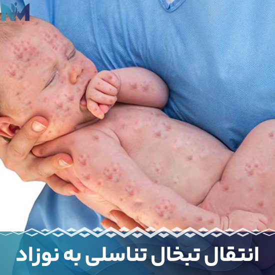 انتقال-تبخال-تناسلی-به-نوزاد
