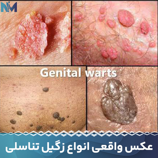 عکس-واقعی-انواع-زگیل-تناسلی