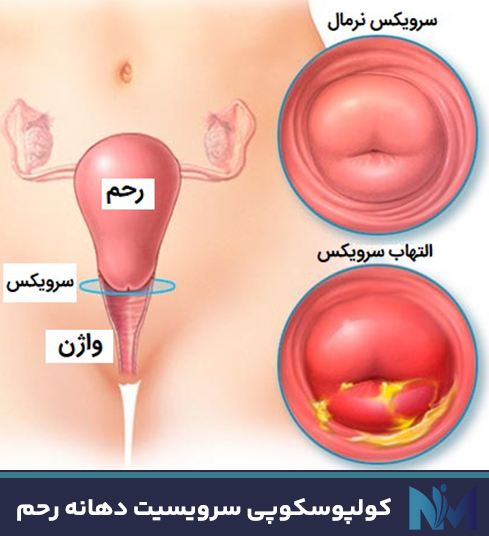 کولپوسکوپی-سرویسیت-دهانه-رحم
